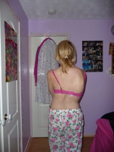 Scoliosis back before surgery