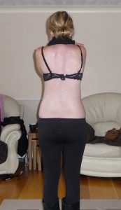 Scoliosis - back after surgery