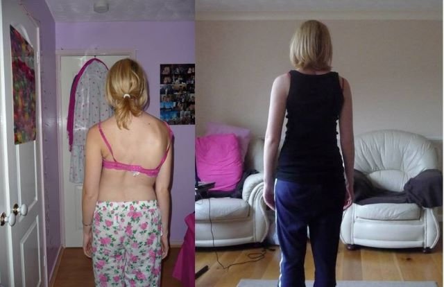 scoliosis - back before and after