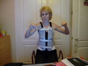 Scoliosis Surgery Recovery
