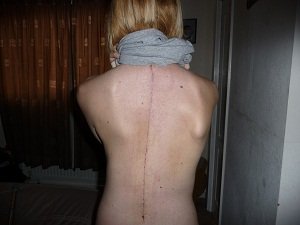 My Scoliosis Scar - 2 weeks post op
