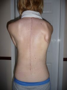 Scoliosis scar after surgery
