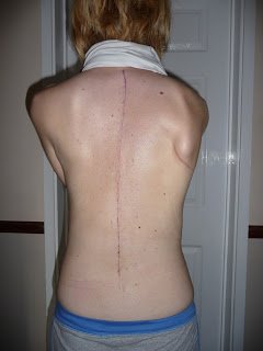 My Scoliosis Scar - 6 weeks post op