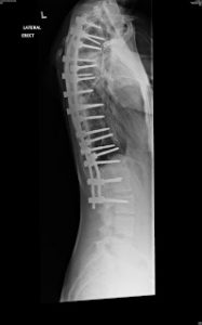 what does it feel like to have metal work in your spine