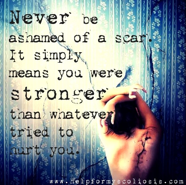 scoliosis-scar-quote-never-be-ashamed