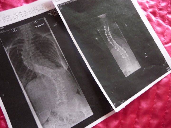 Scoliosis X-rays
