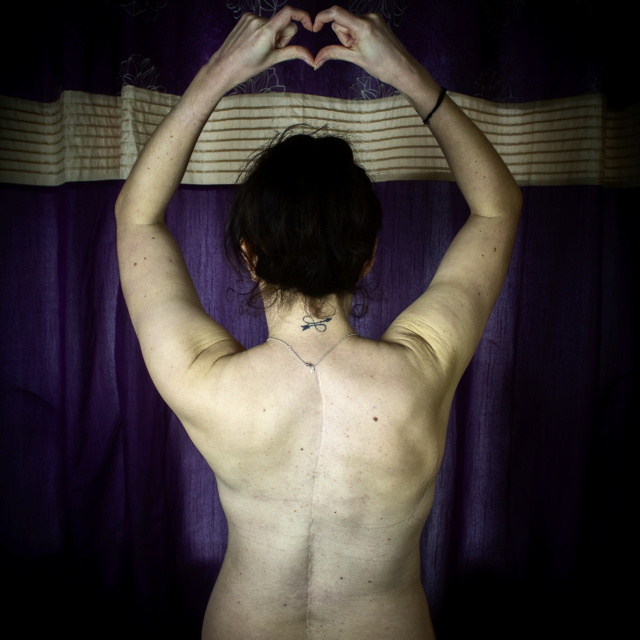 5 Reasons to Love Your Scars - My scoliosis scar