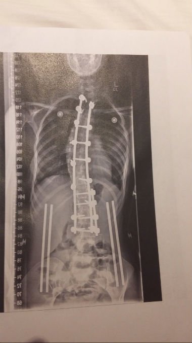 Your Scoliosis Stories Rachel Xray after