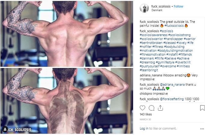 Inspiring Scoliosis Instagram Accounts My Top 10 Life With Scoliosis