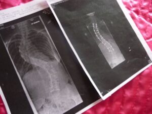 Scoliosis X-Rays Front View
