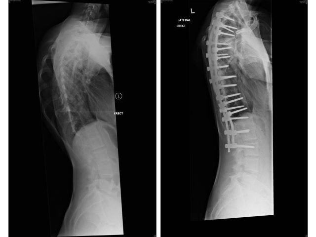 Scoliosis X-Rays Side View