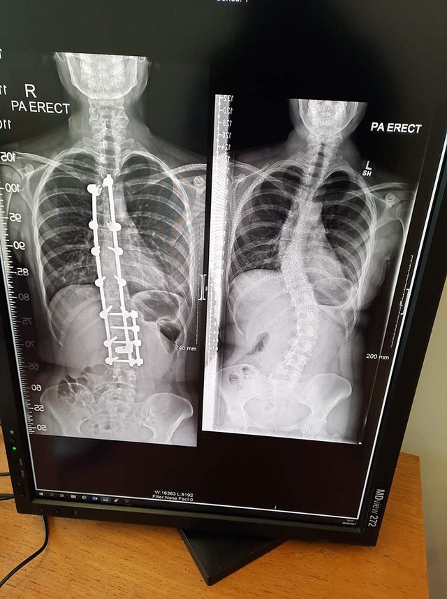 Scoliosis X-rays before and after surgery