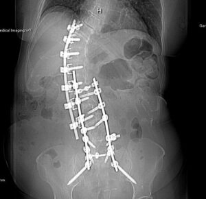 Isabel Scoliosis Xray